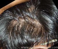 Alopecia-After 4 months